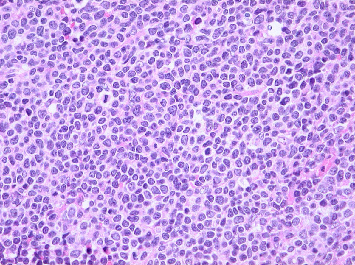 mantle-cell-lymphoma.jpg